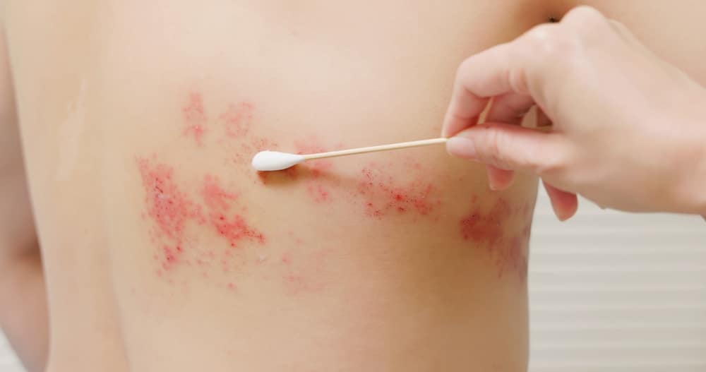 Doctor taking a swap of rash on person's back to test for shingles.