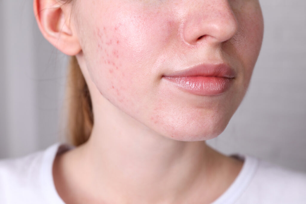 Woman examining facial redness and rosacea symptoms.